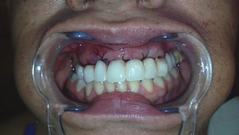 Boiano Dental Implant Specialists in Throgs Neck Bronx 768x433